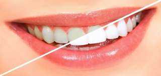 من منزلك ..وصفات طبيعية فعالة لتبييض الأسنان